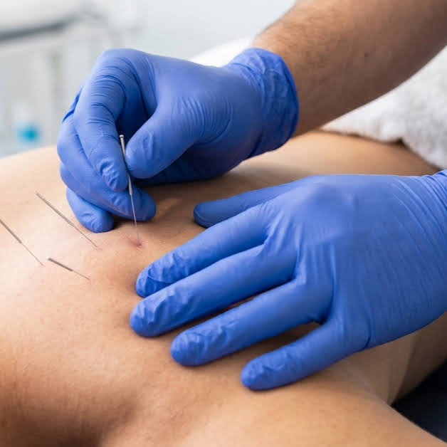 Dry needling physical therapy at Mountain Town Rehab in Mt. Pleasant, MI